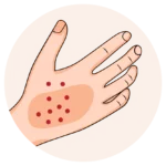 Severe allergic reaction — call 911 or go to an emergency room