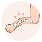 Severe or open bone injury — call 911 or go to an emergency room